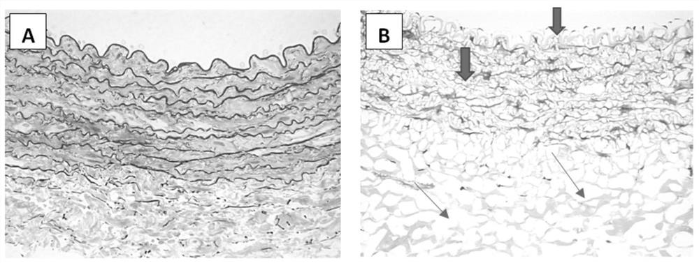 A blood vessel ice crystal-free cryopreservation solution and blood vessel preservation method