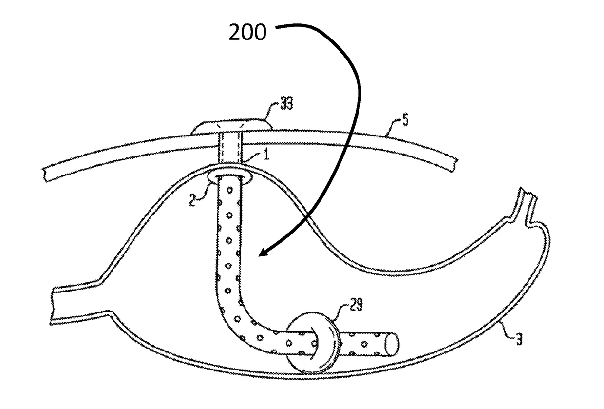 Modified apparatus for food extraction and obesity treatment