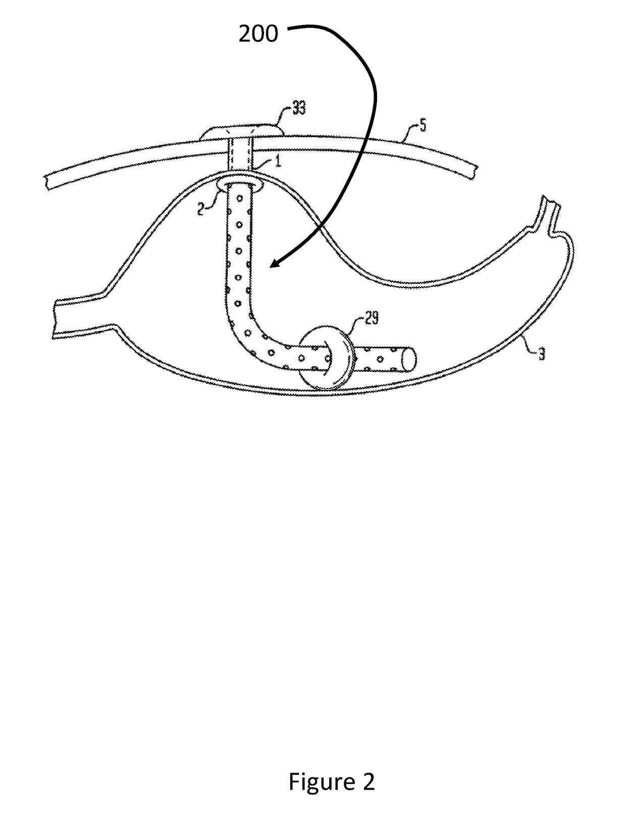 Modified apparatus for food extraction and obesity treatment