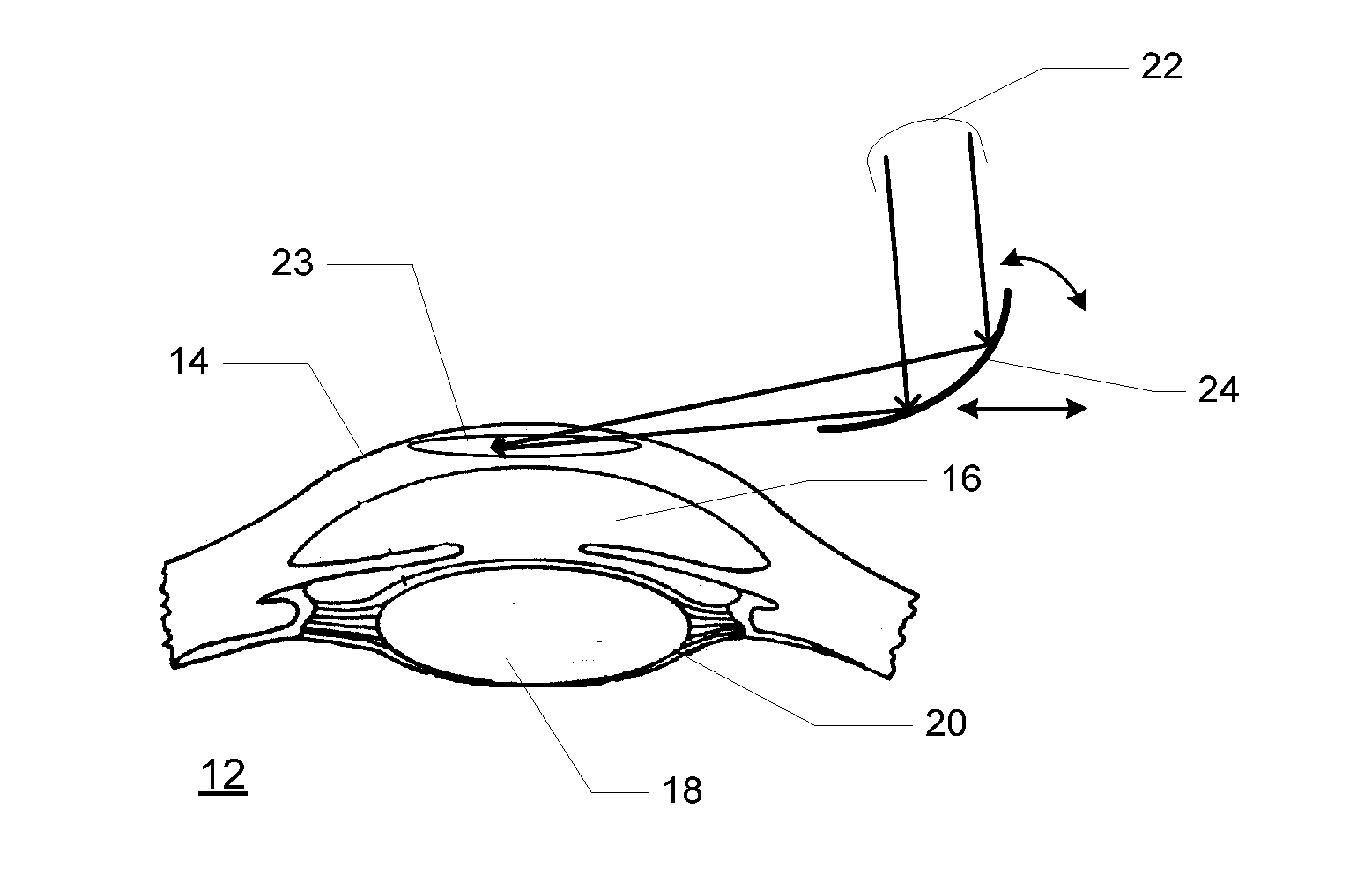 Method and Device for Cornea Reshaping by Intrastromal Tissue Removal