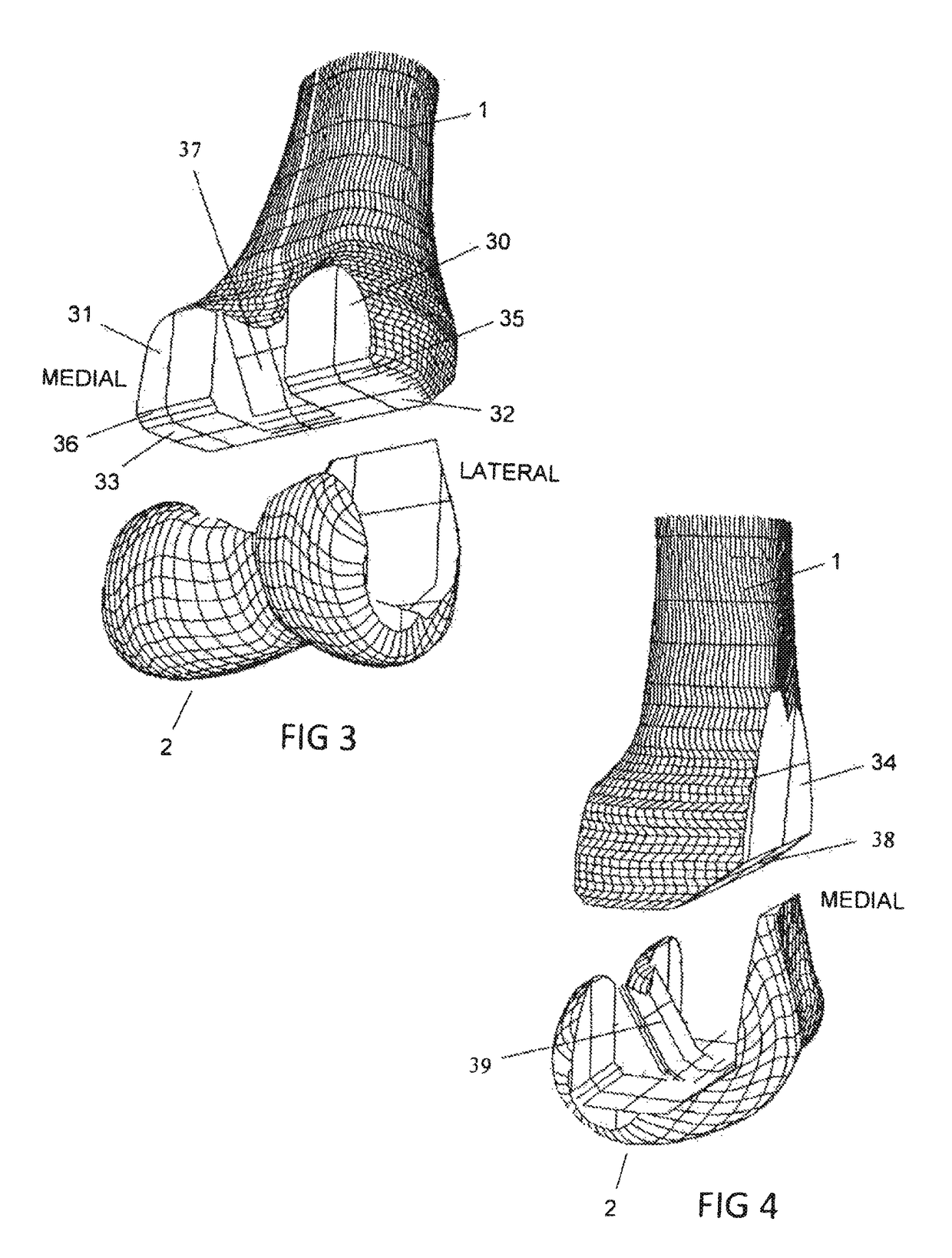 Total knee replacement implant based on normal anatomy and kinematics