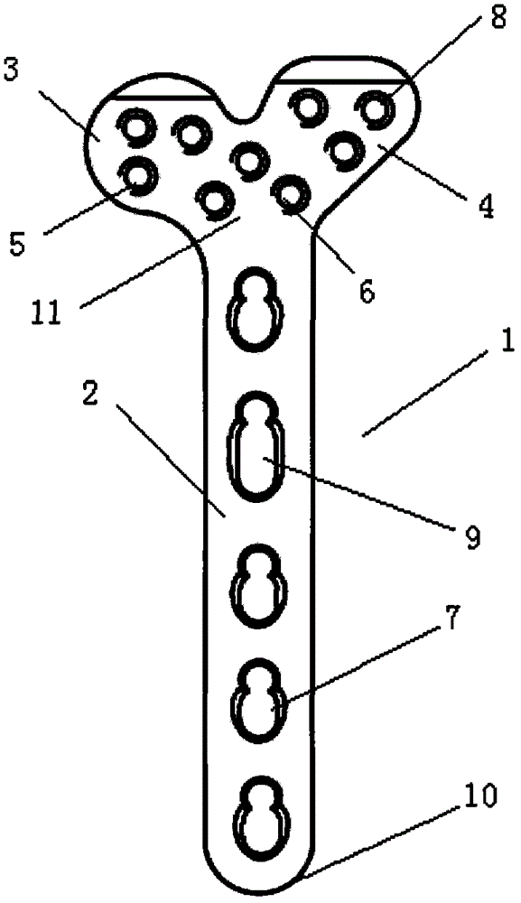Double-column locking plate for distal radius palmaris