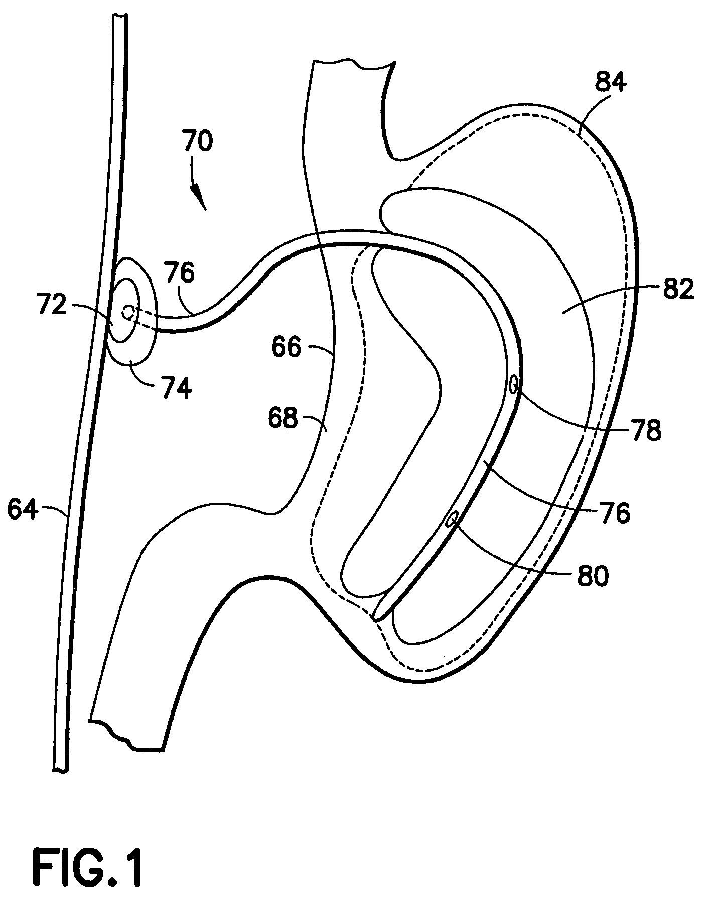 Gastro-occlusive device