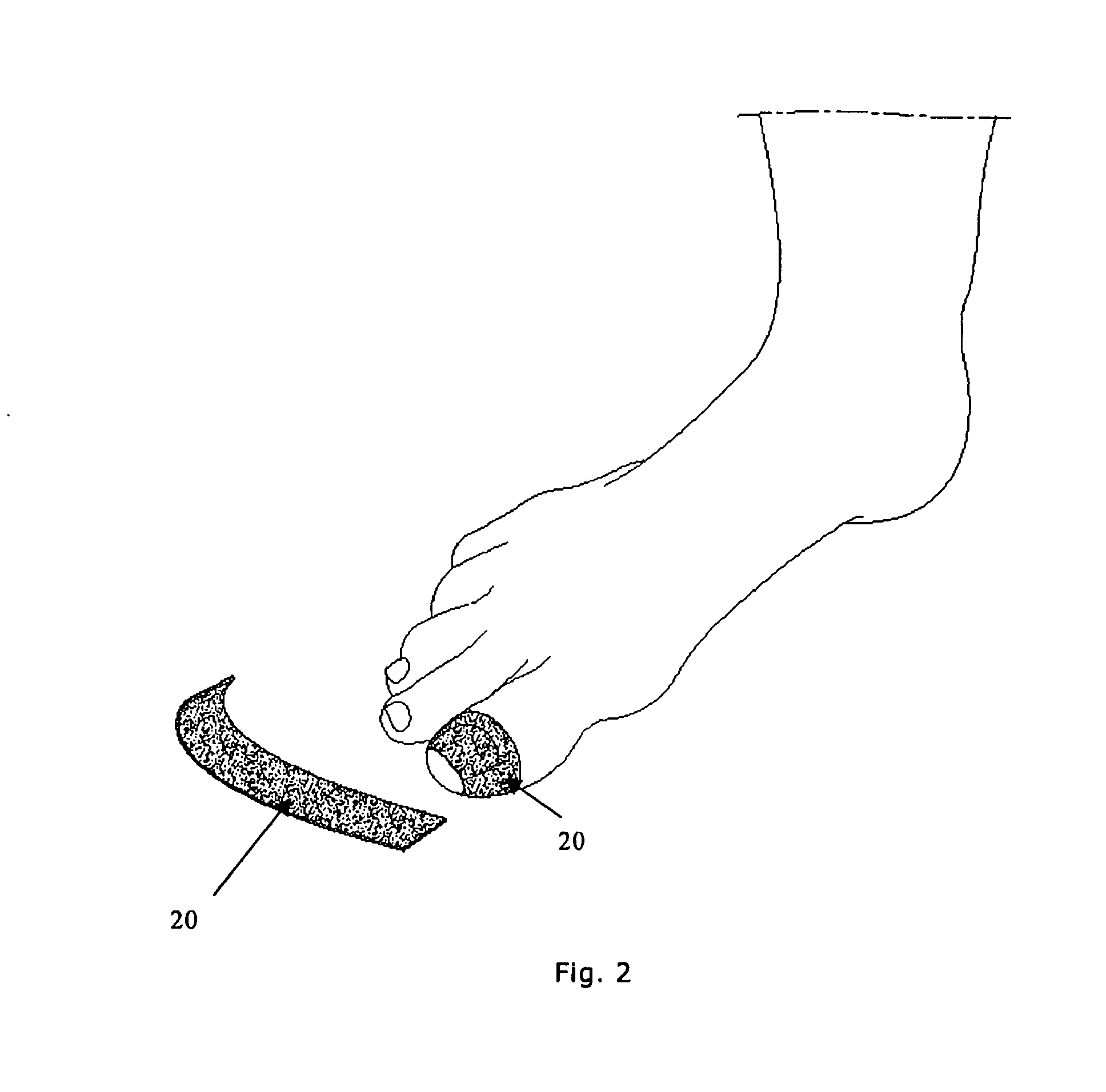 Device and method for treatment of dermatomycosis, and in particular onychomycosis