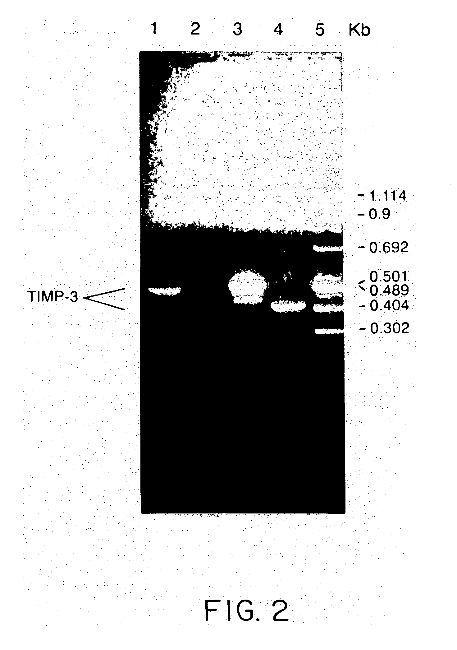 Tissue inhibitor of metalloproteinase type three (TIMP-3) composition and methods