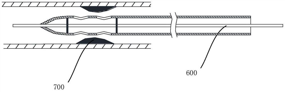 Suction catheter with side hole and device