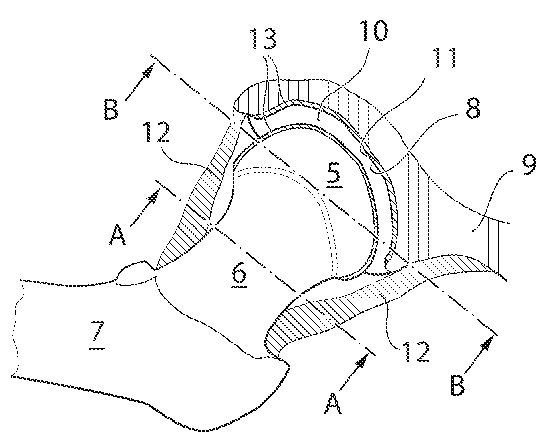 Hip joint device and method