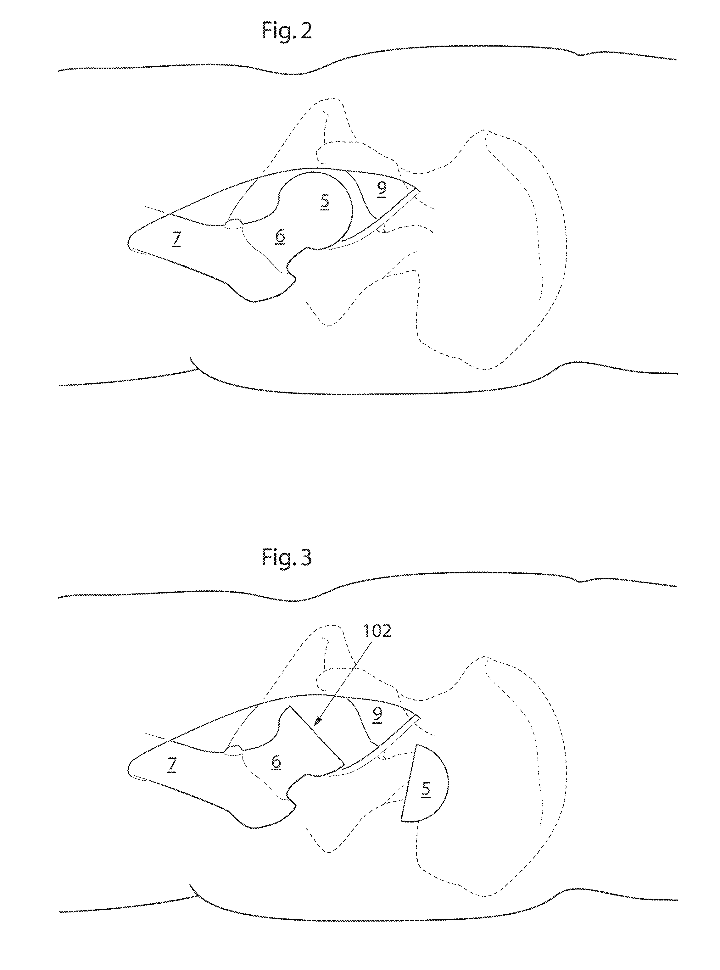 Hip joint device and method