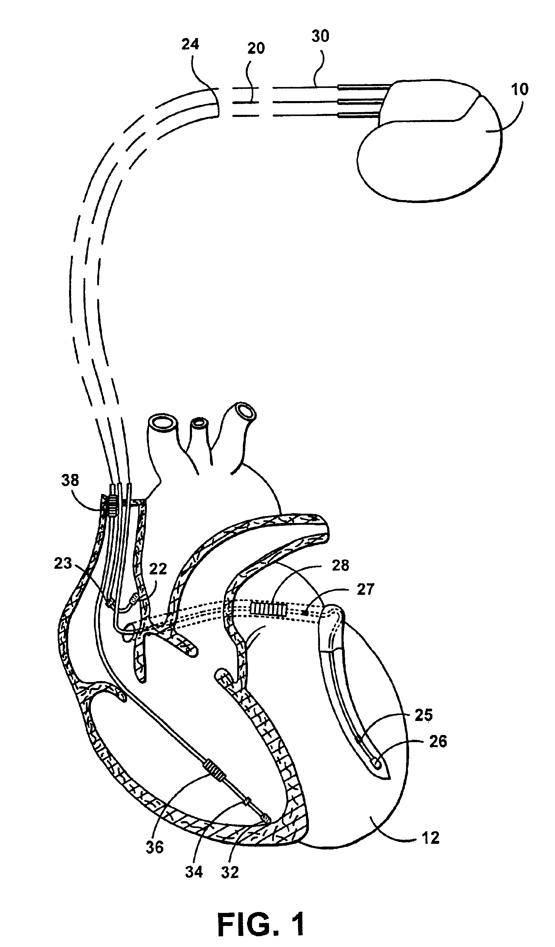 Automatic capture using independent channels in bi-chamber stimulation
