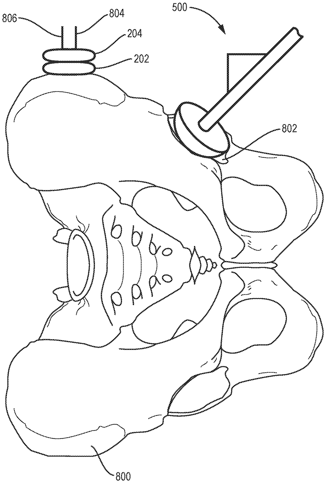 Patient-specific prosthesis alignment