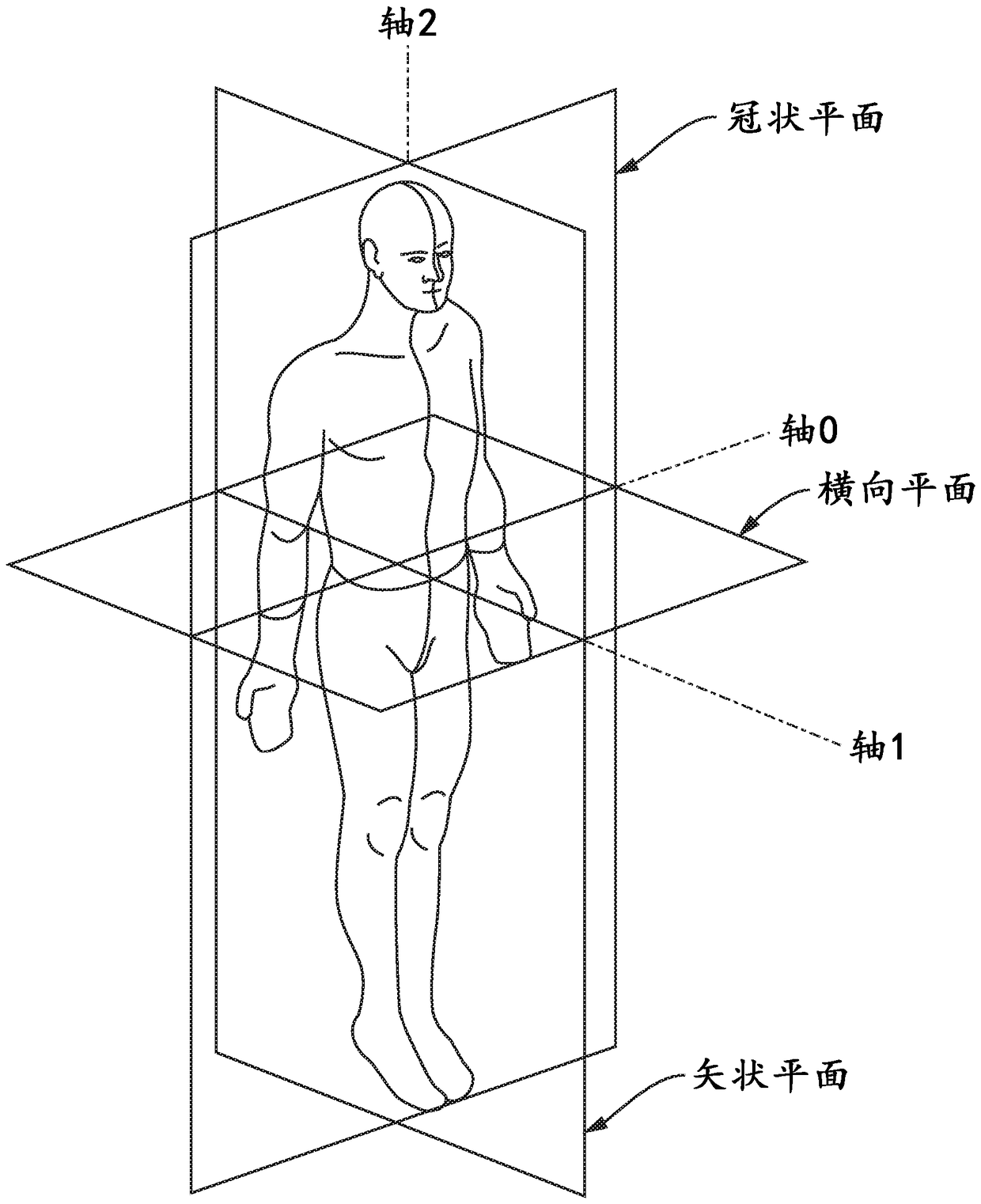 Patient-specific prosthesis alignment