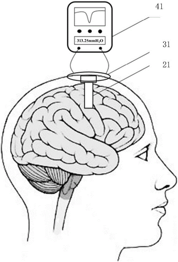 Embedded wireless passive intracranial pressure monitoring system