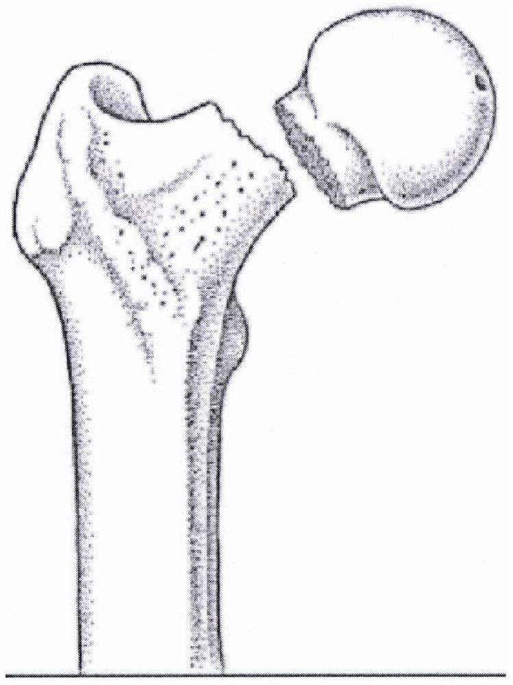 Degradable shape memory femur internal fixator