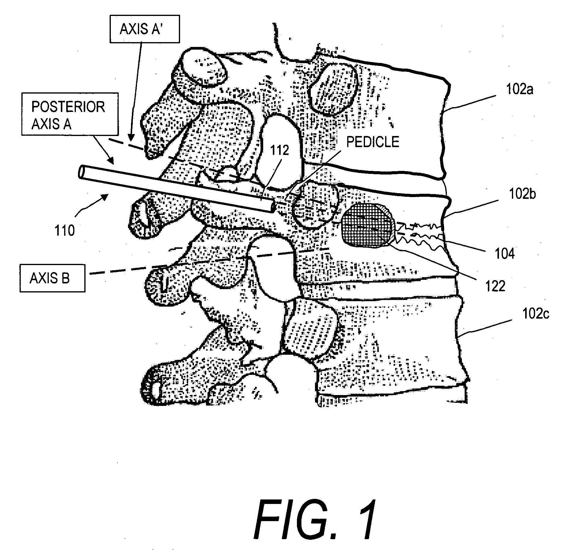 Stent systems and methods for spine treatment