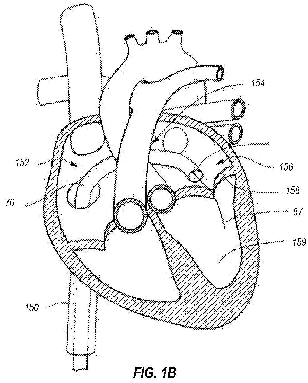 Systems and methods for delivering and deploying an artificial heart valve within the mitral annulus