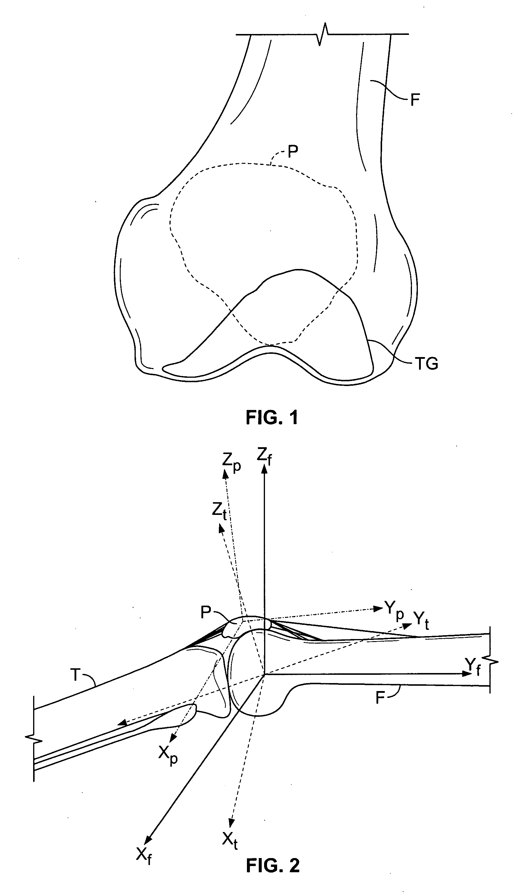 System and method for diagnosing and treating patellar maltracking and malalignment