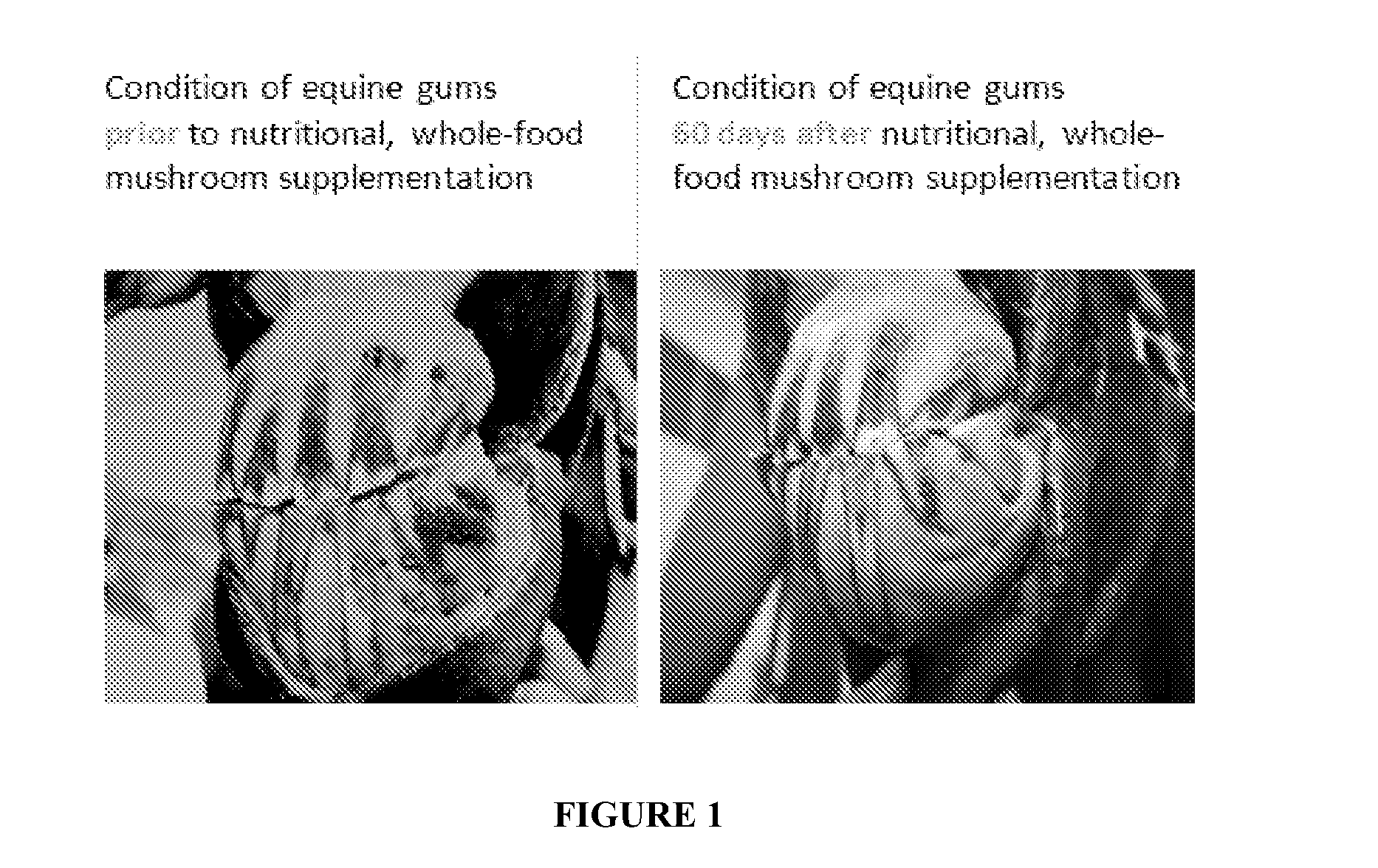 Nutritional approach to the control of anemia, diabetes and other diseases or conditions and prevention of associated comorbid states with the use of ergothioneine