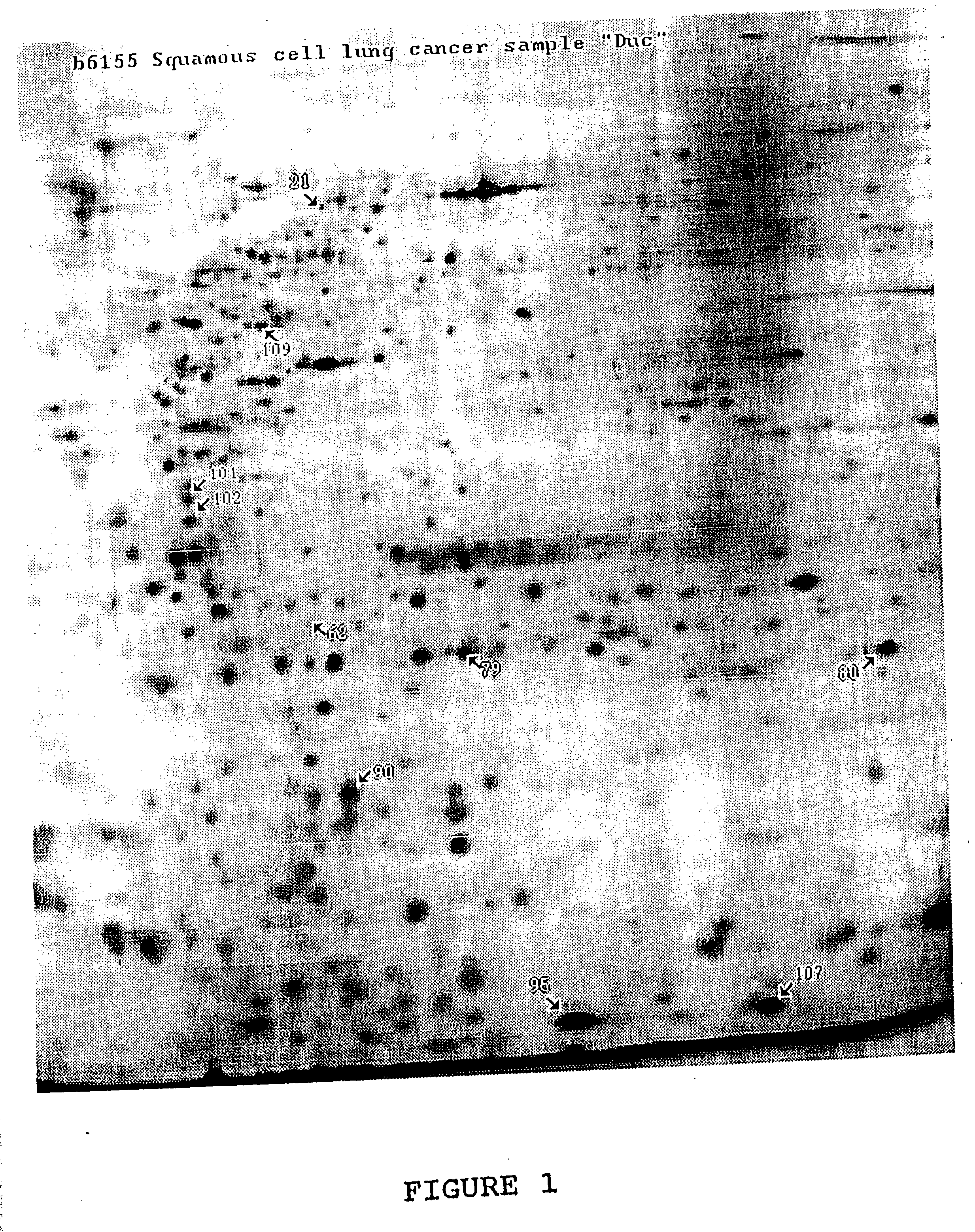 Protein markers for lung cancer and use thereof