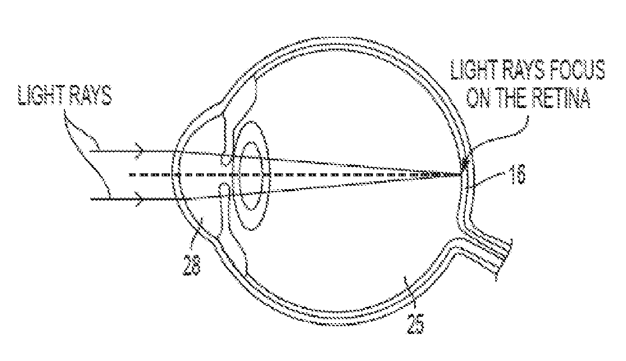 Minimally-invasive method and apparatus for restructuring the retina