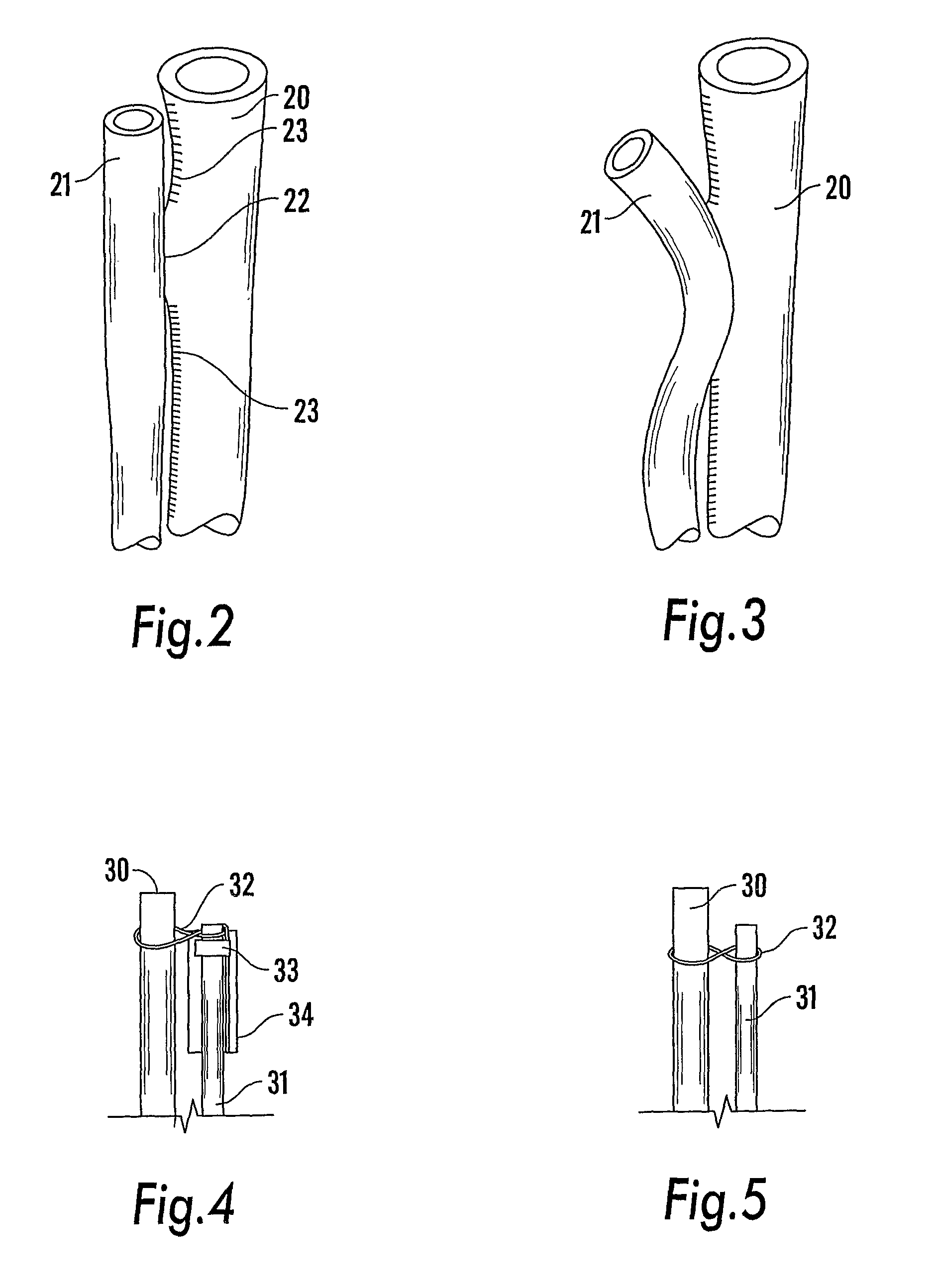 Endoluminal surgical delivery system