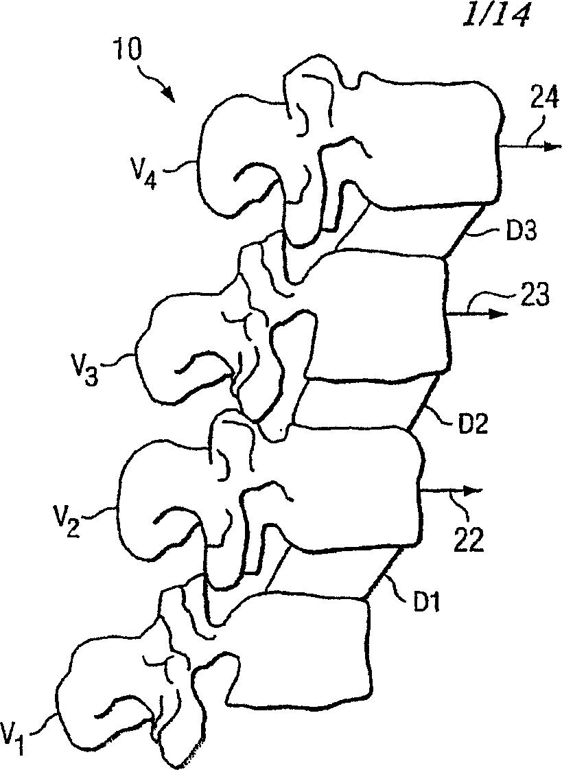 Articular disc prosthesis for anterior-oblique insertion