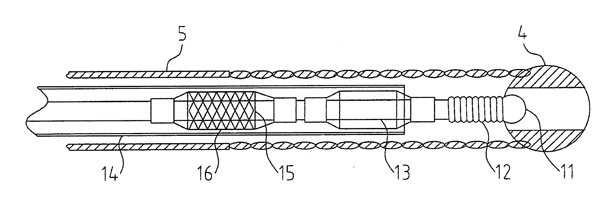 Angioplasty assembly