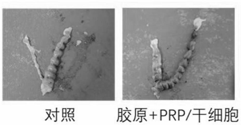 Preparation method and application of temperature-sensitive composite hydrogel preparation for endometrial repair