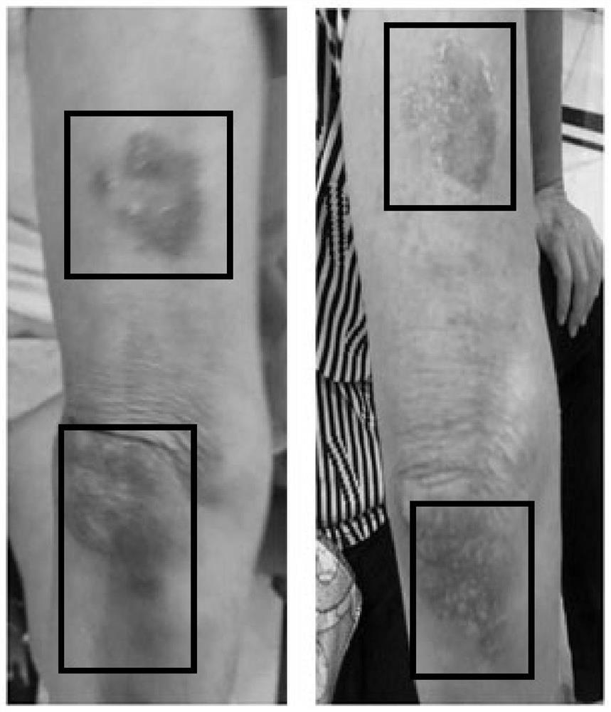 Protein film dressing beneficial to wound healing based on cooperation of three bioactive scaffold materials and cytotrophic factors