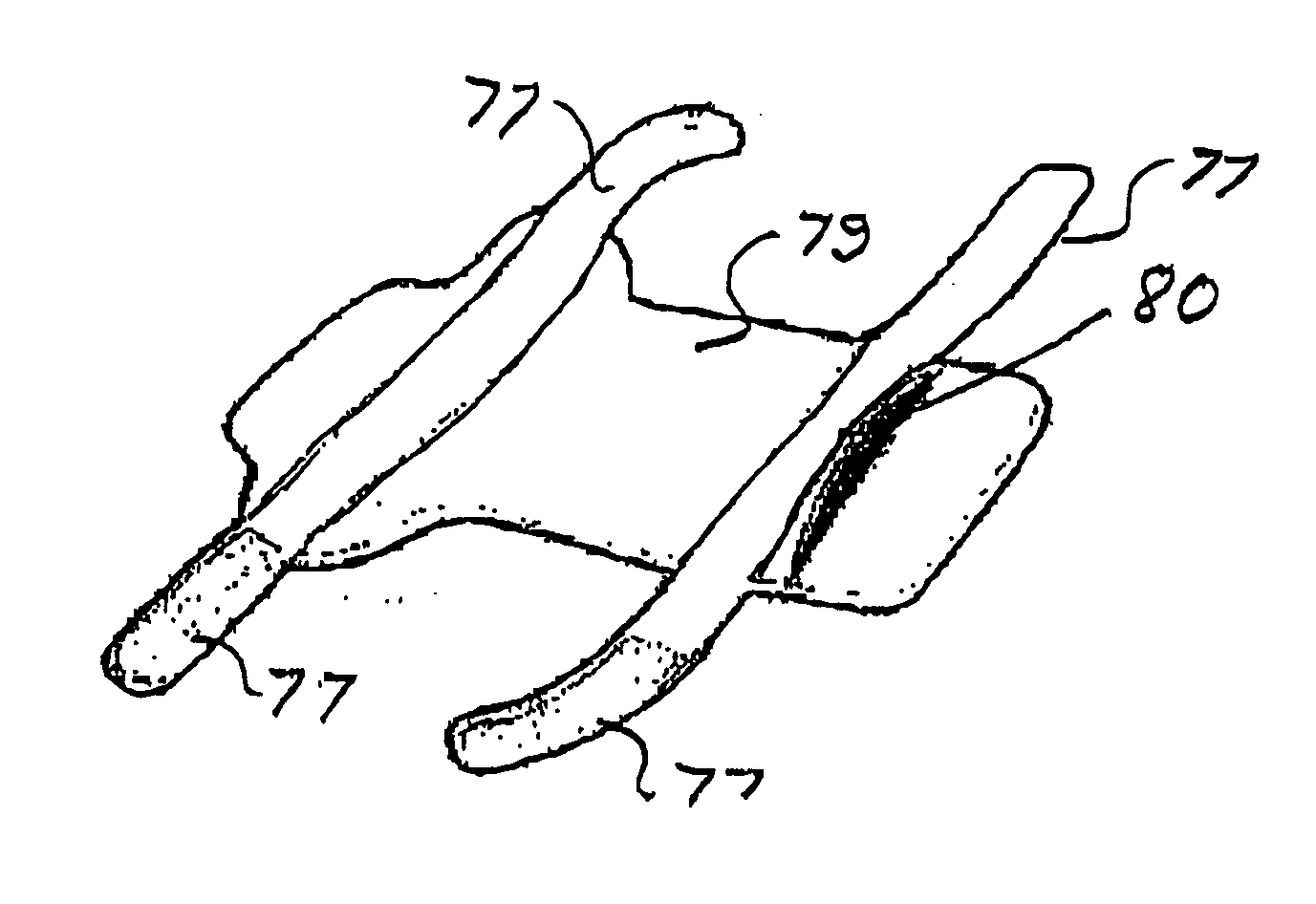 Pressure ulcer prosthesis and method for treating and/or preventing pressure ulcers