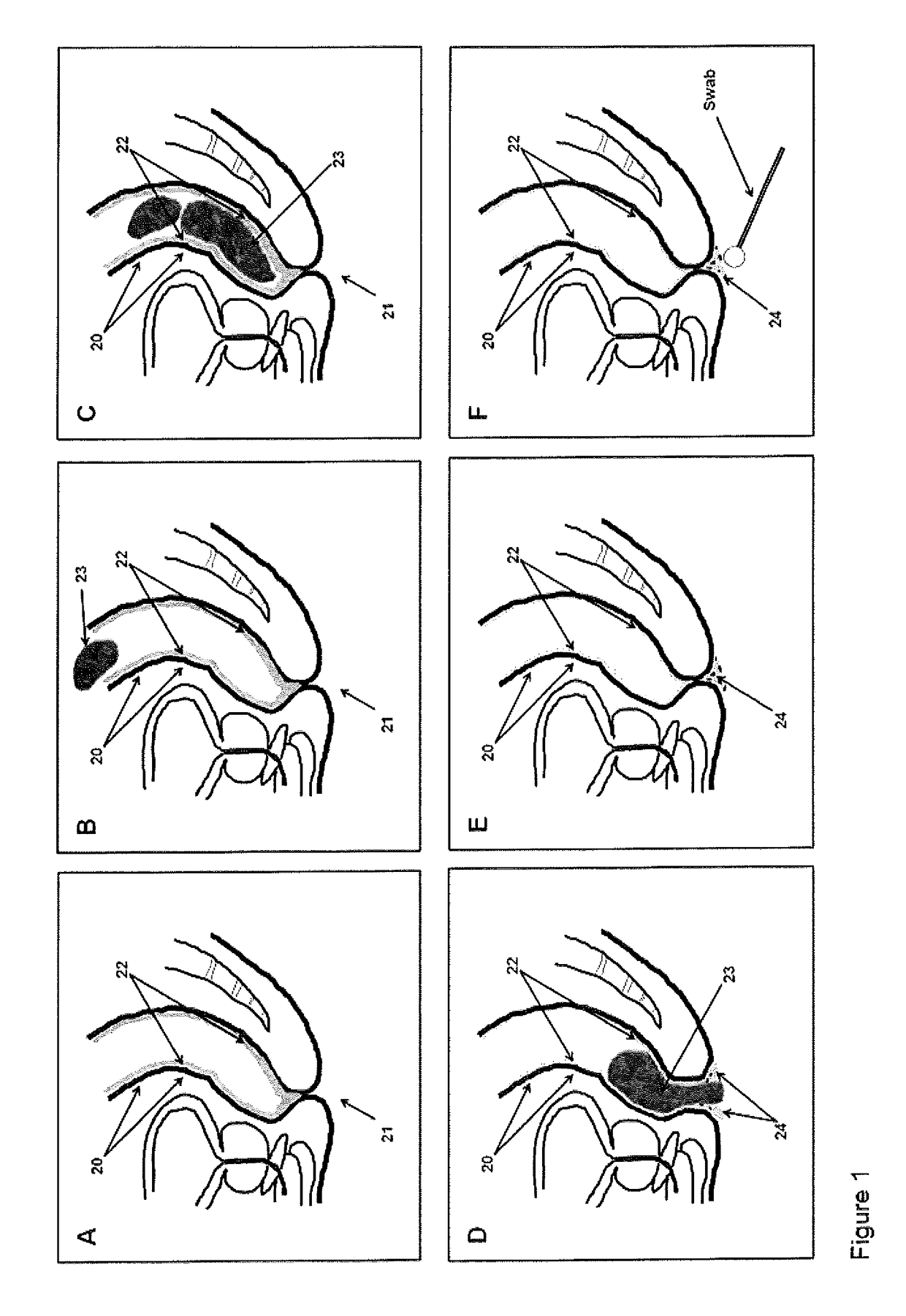 Method for diagnosing inflammatory bowel disease