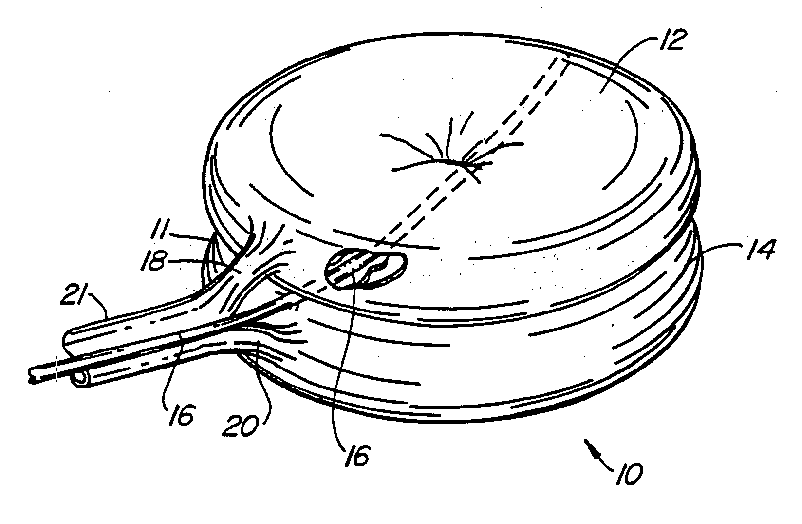 Inflatable device for use in surgical protocol relating to fixation of bone