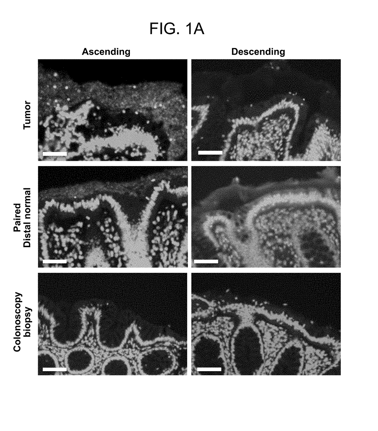 Biofilm formation to define risk for colon cancer