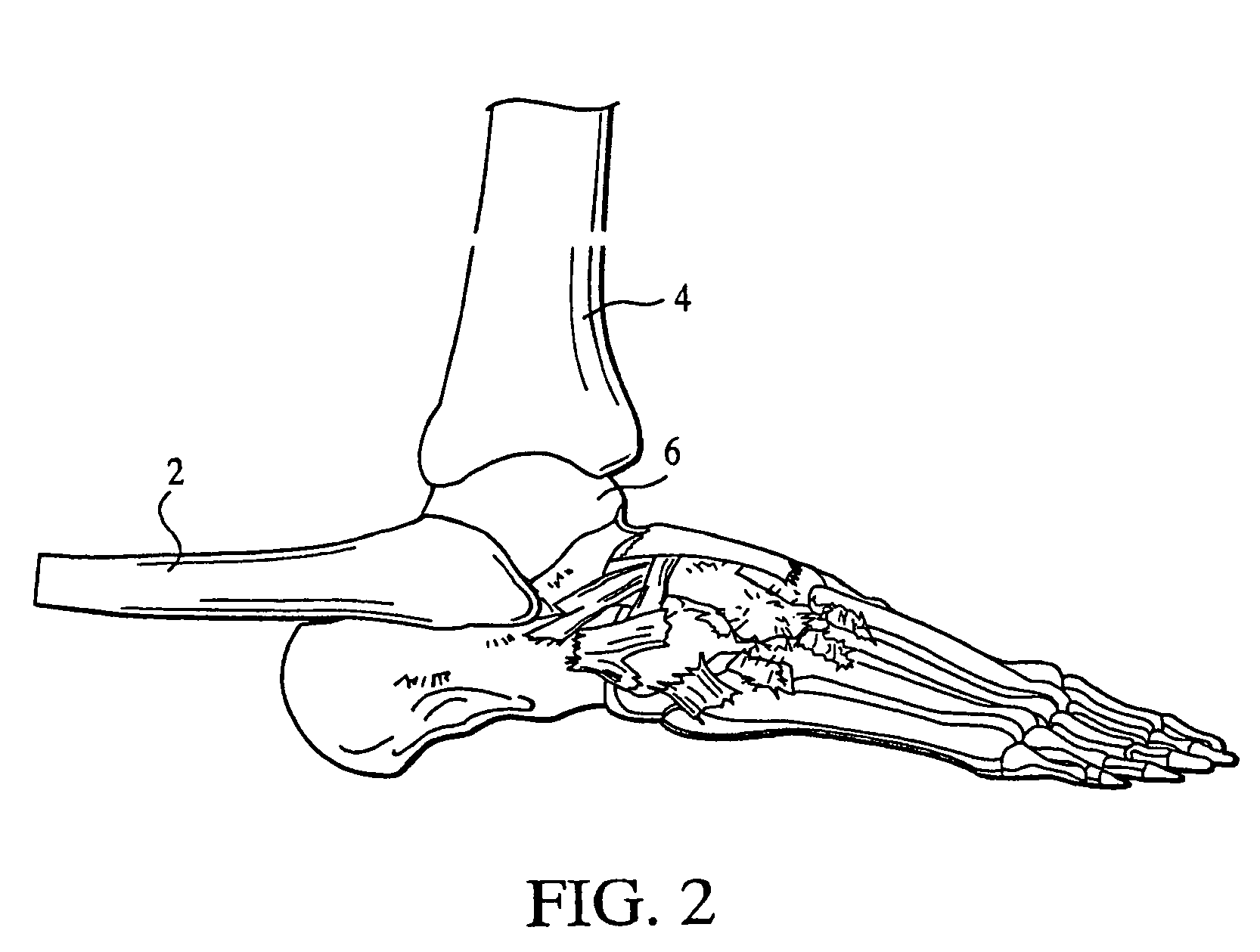 Ankle joint prosthesis and its method of implantation