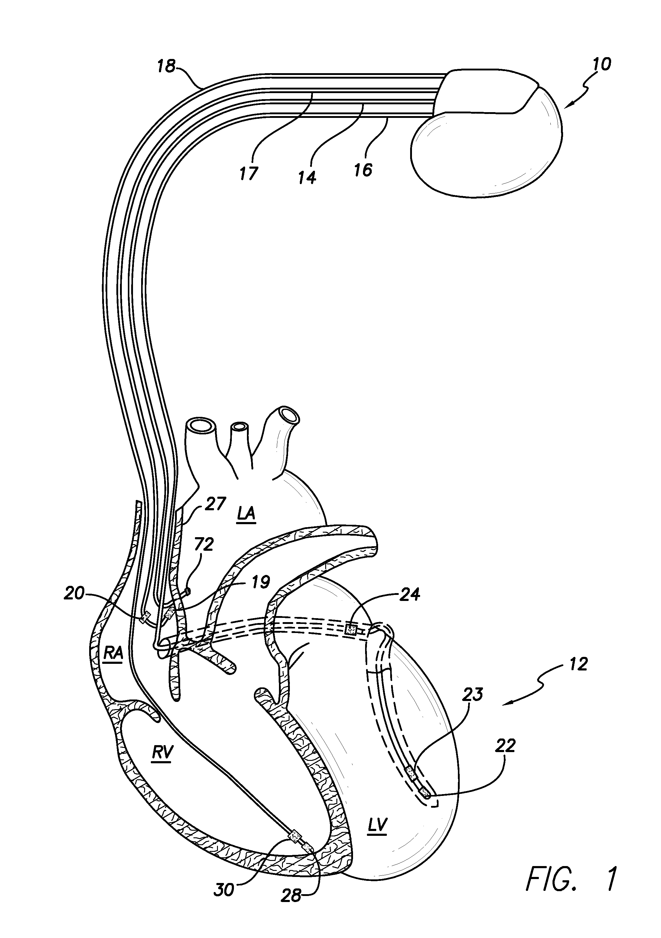 Method and system for stimulating a heart of a patient