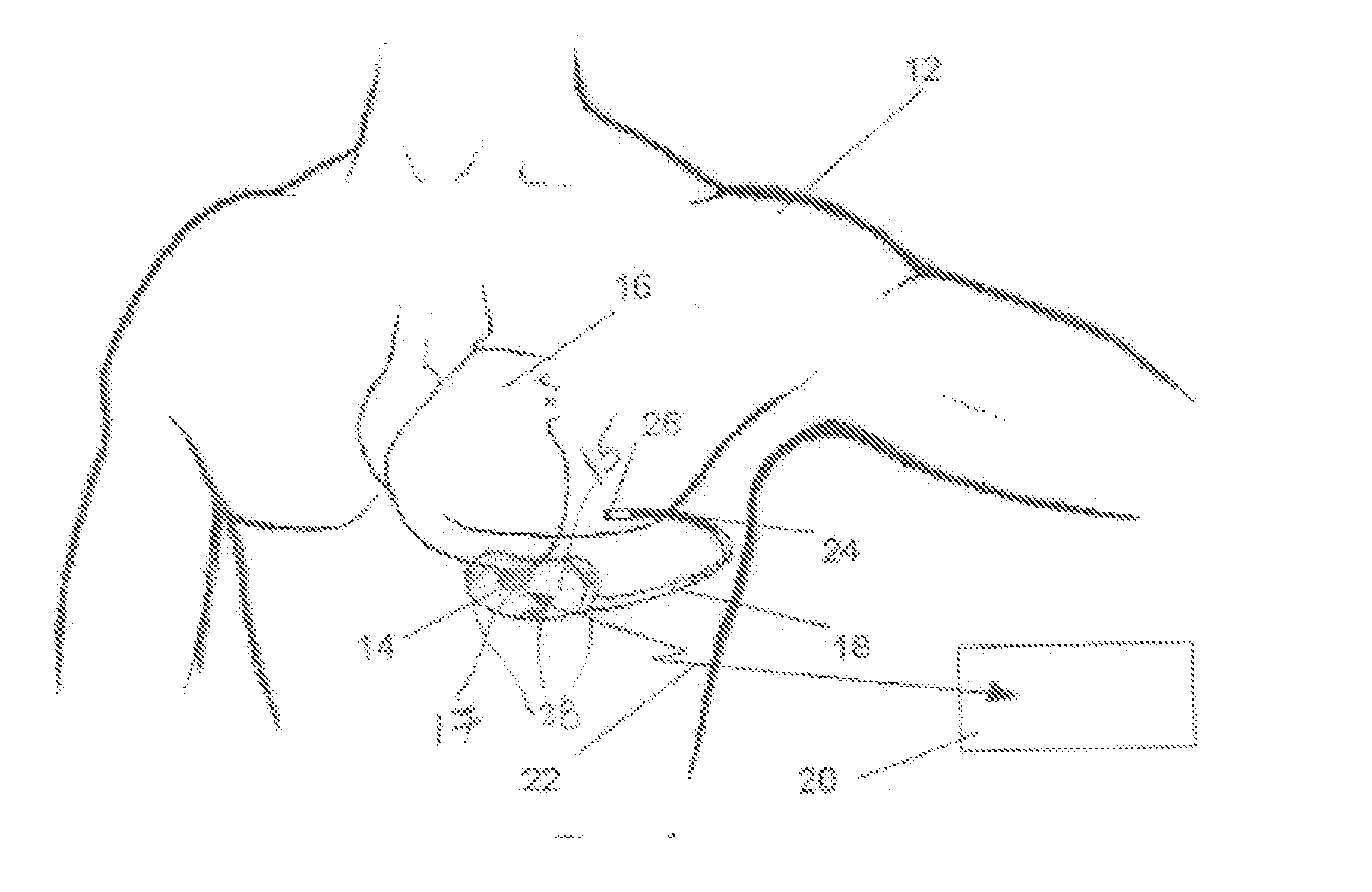 Method and apparatus for verifying a determined cardiac event in a medical device based on detected variation in hemodynamic status