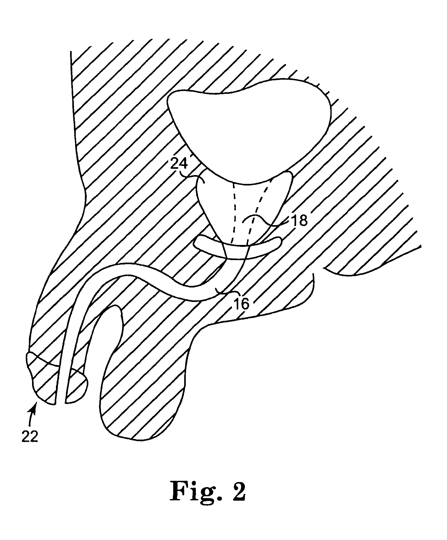 Method and articles for treatment of stress urinary incontinence
