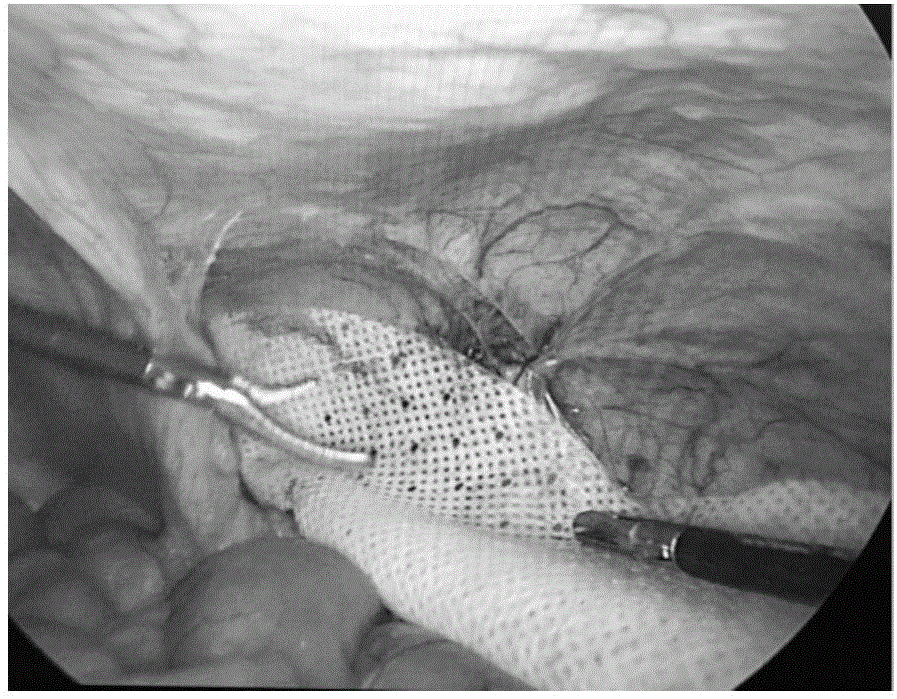 Bracket type sticking piece for adult inguinal hernia TAPE surgical repairing