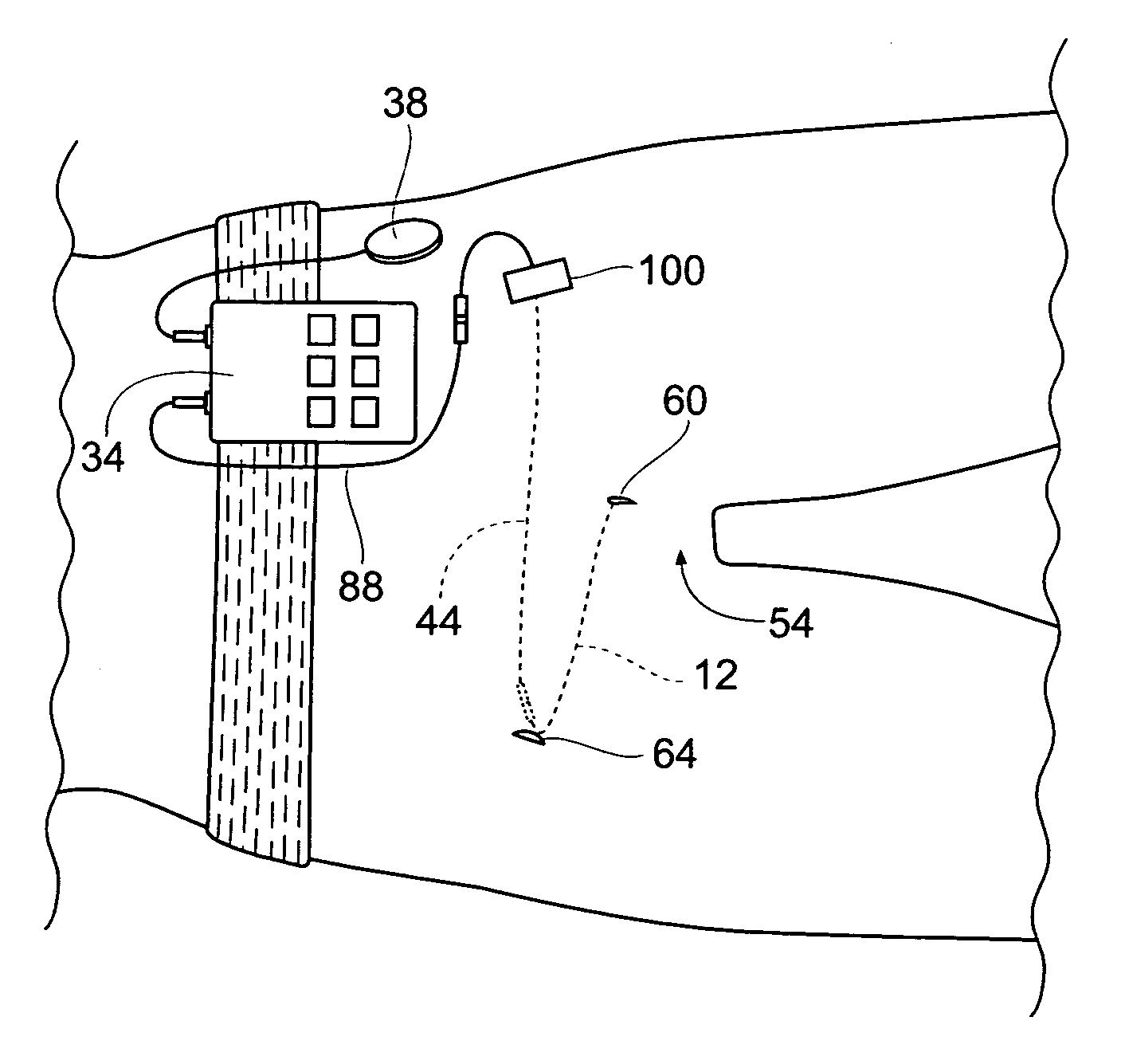 Systems and methods for bilateral stimulation of left and right branches of the dorsal genital nerves to treat dysfunctions, such as urinary incontinence