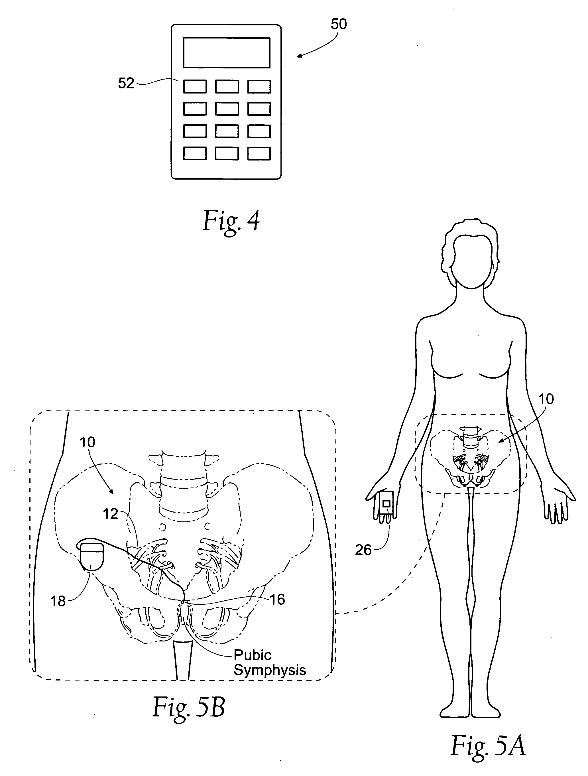 Systems and methods for bilateral stimulation of left and right branches of the dorsal genital nerves to treat dysfunctions, such as urinary incontinence