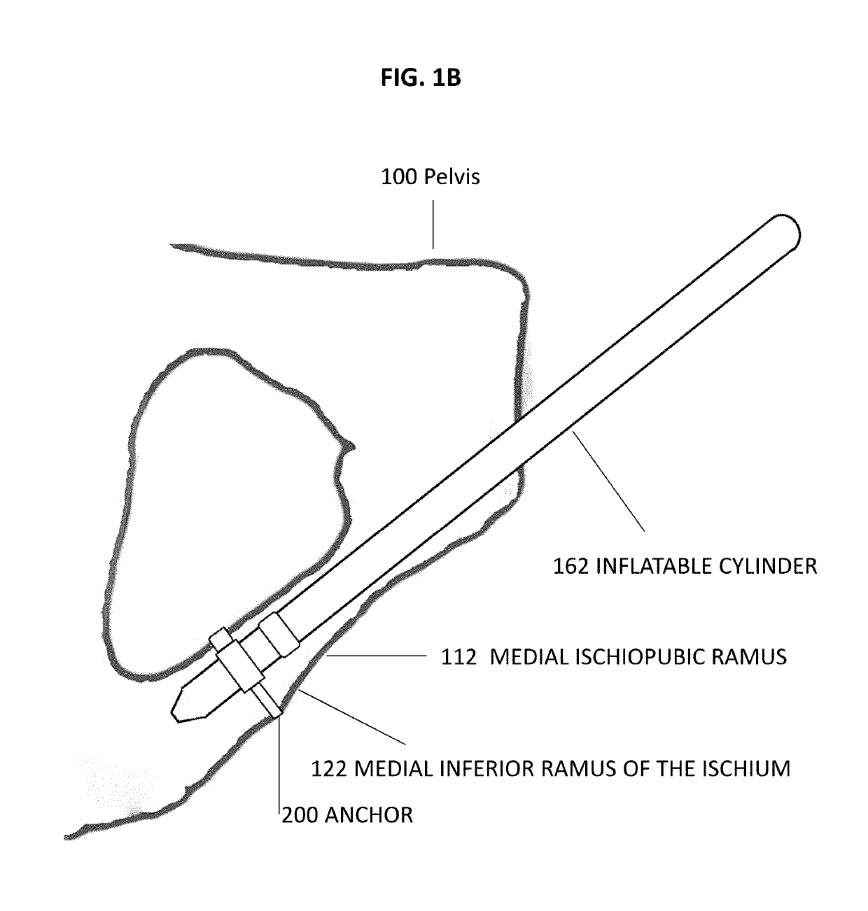 Pelvic anchor for penile prosthetic implants