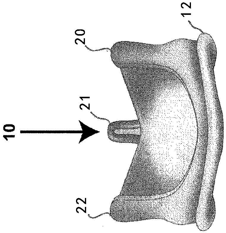 Methods for inhibiting stenosis, obstruction, or calcification of stented heart valve or bioprosthesis