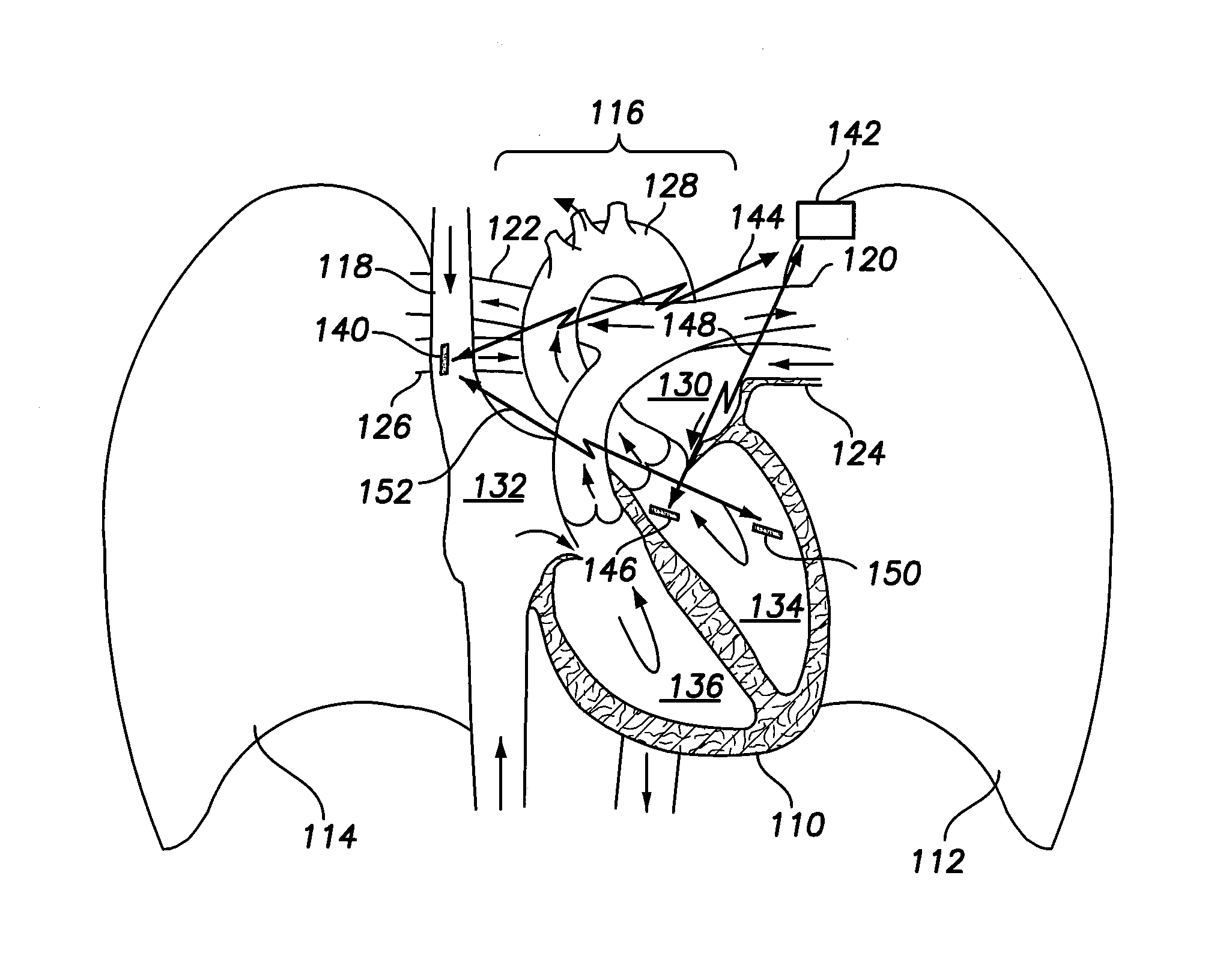 Method and system for discriminating and monitoring atrial arrhythmia based on cardiogenic impedance