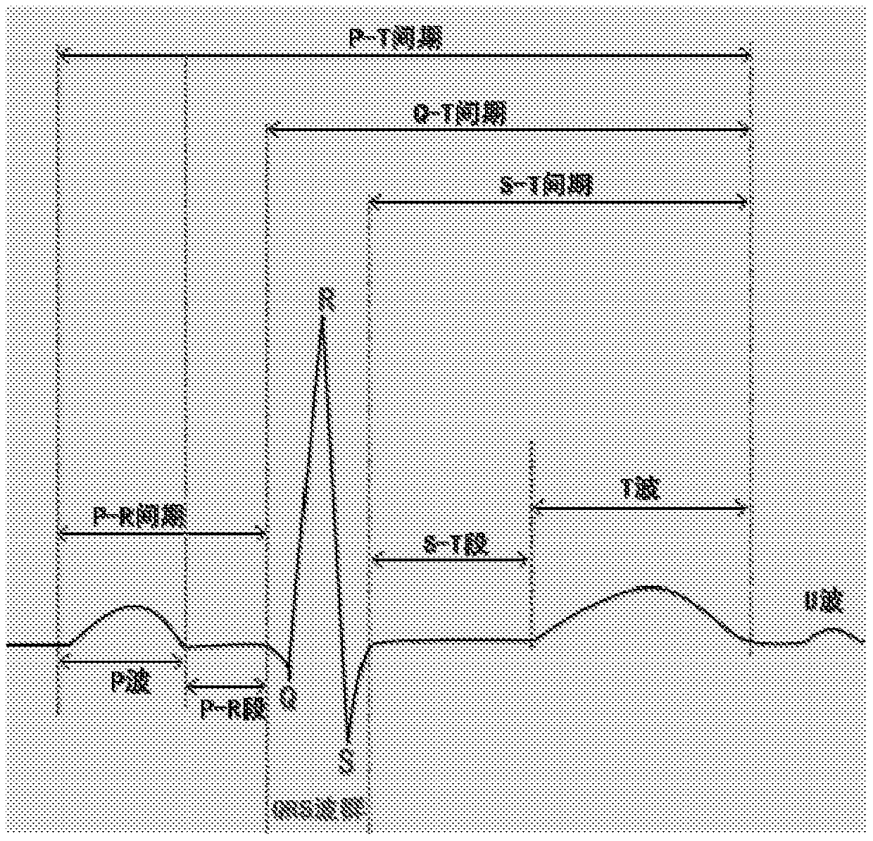 A kind of ecg signal processing method and device