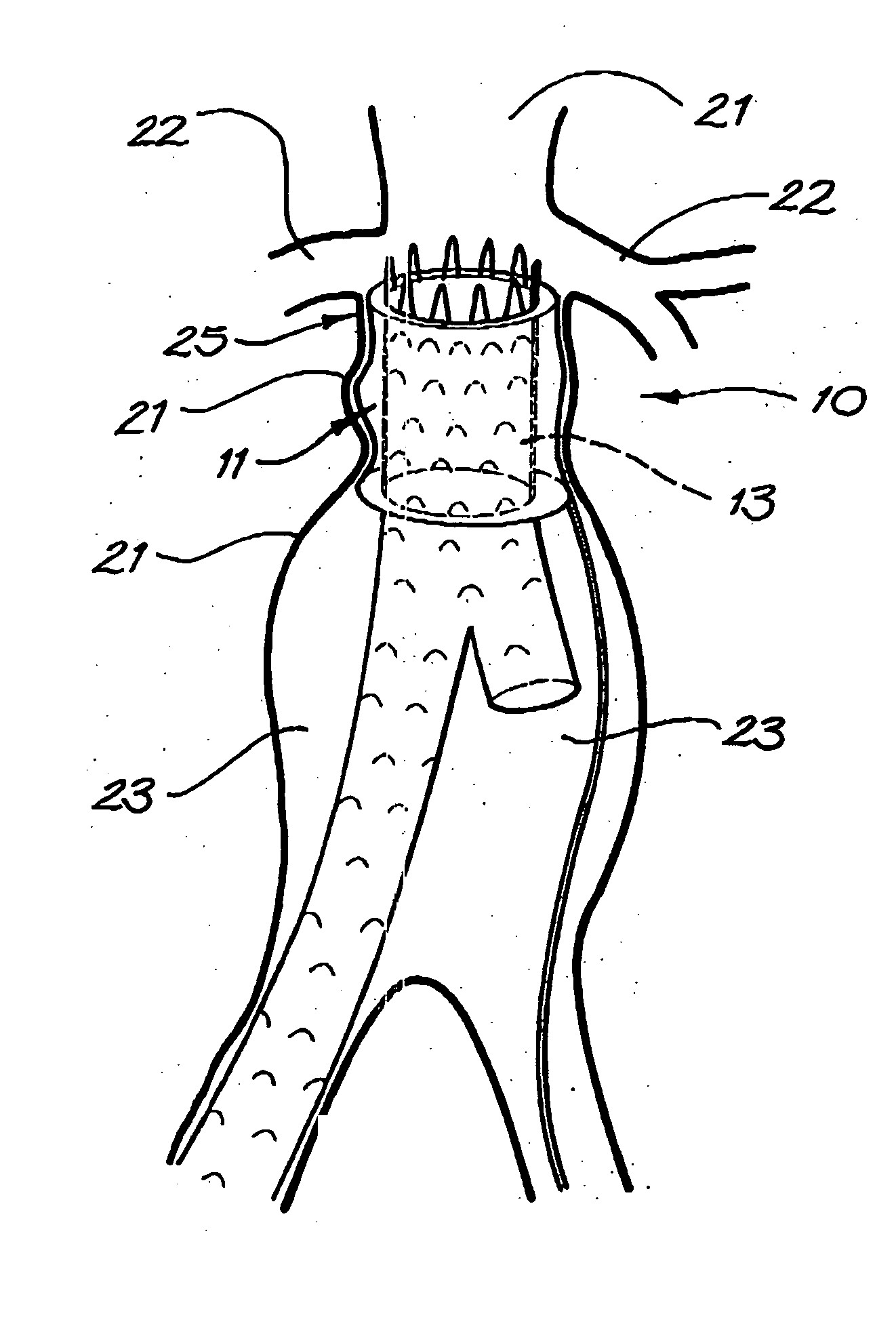 Device for use in intraluminal grafting