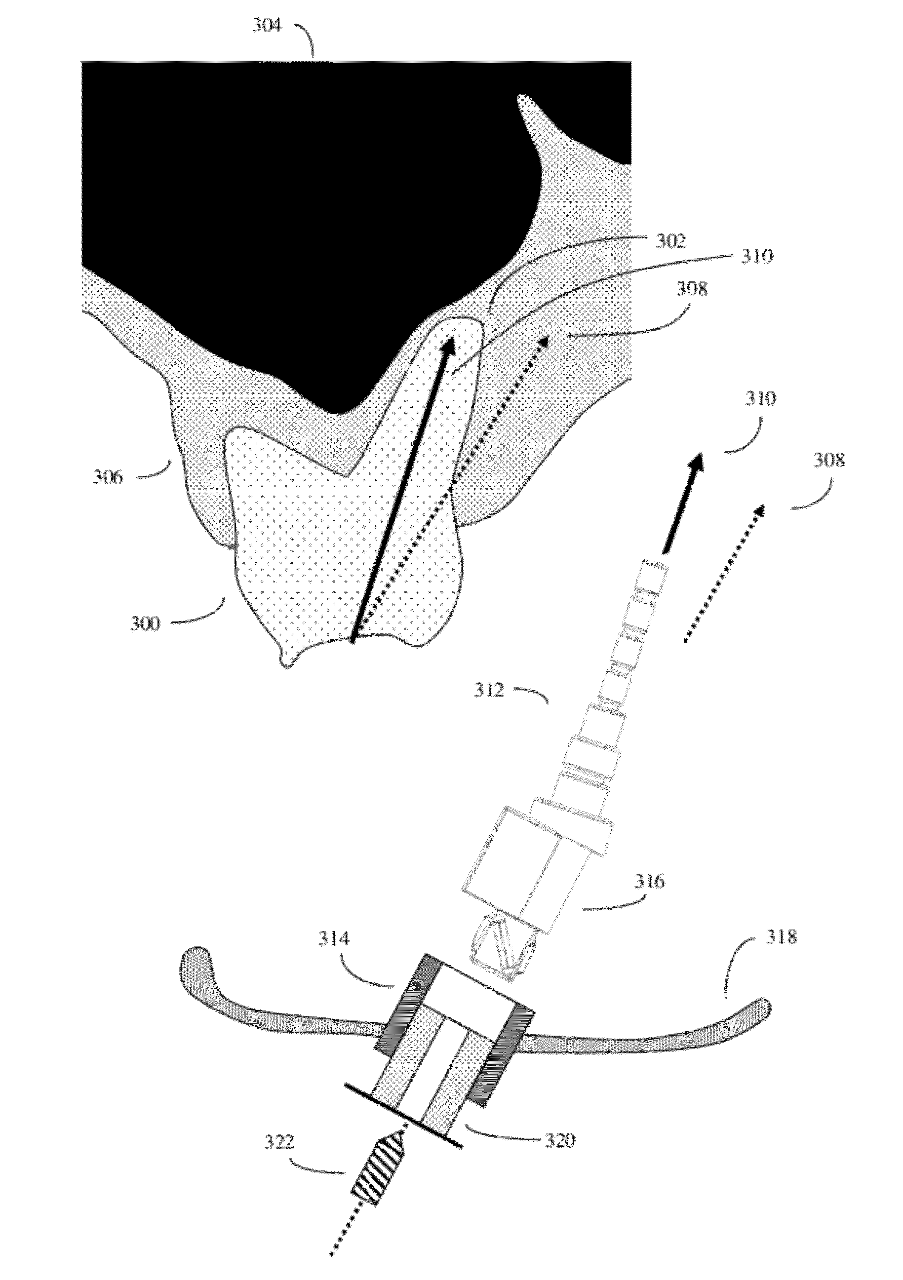 Method and kit for dental implant drilling guides