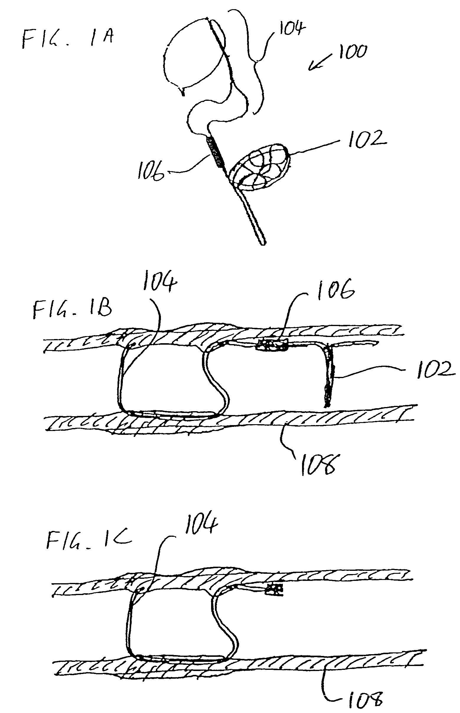 Intravascular devices, retrieval systems, and corresponding methods