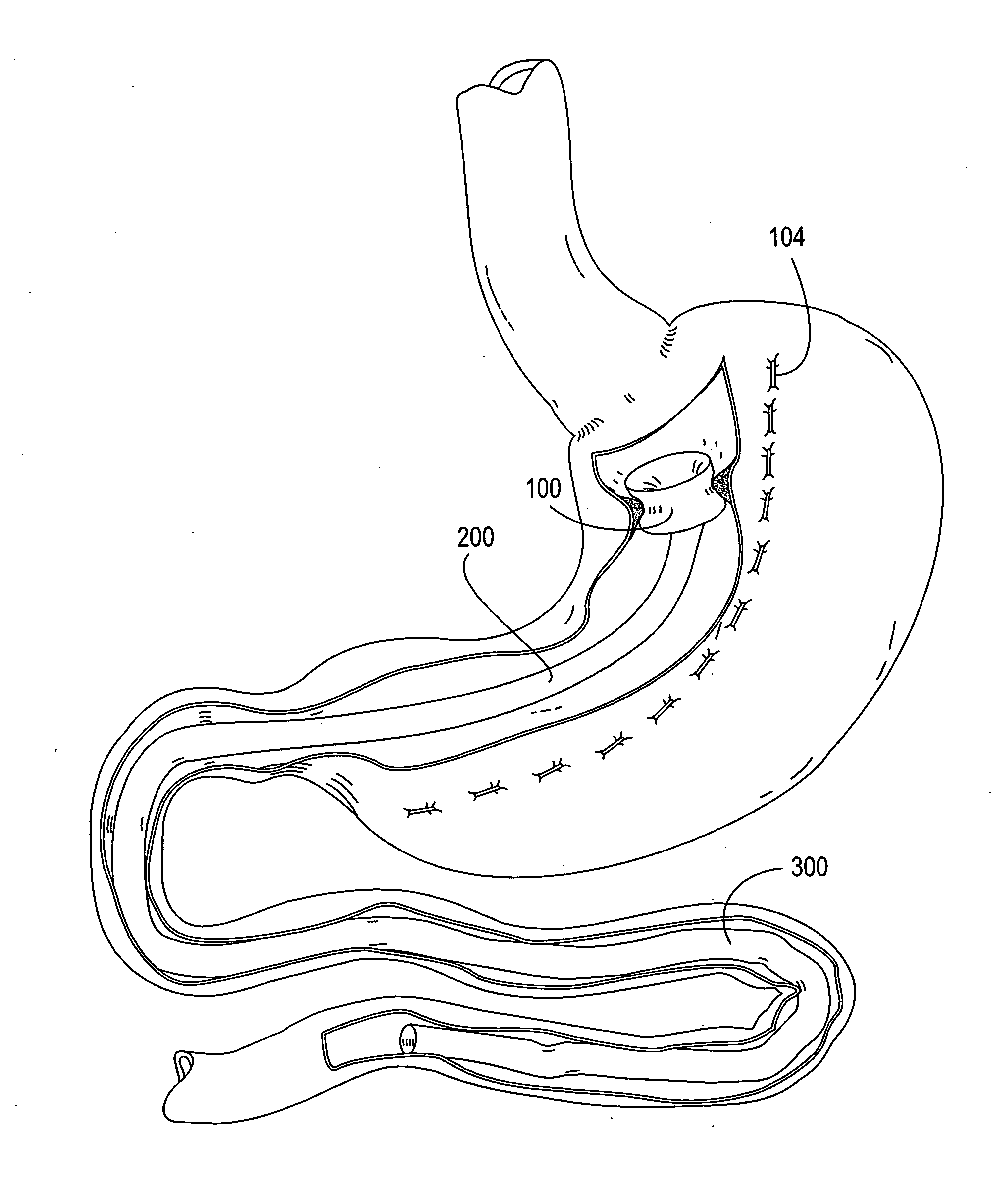 Apparatus and methods for treatment of morbid obesity