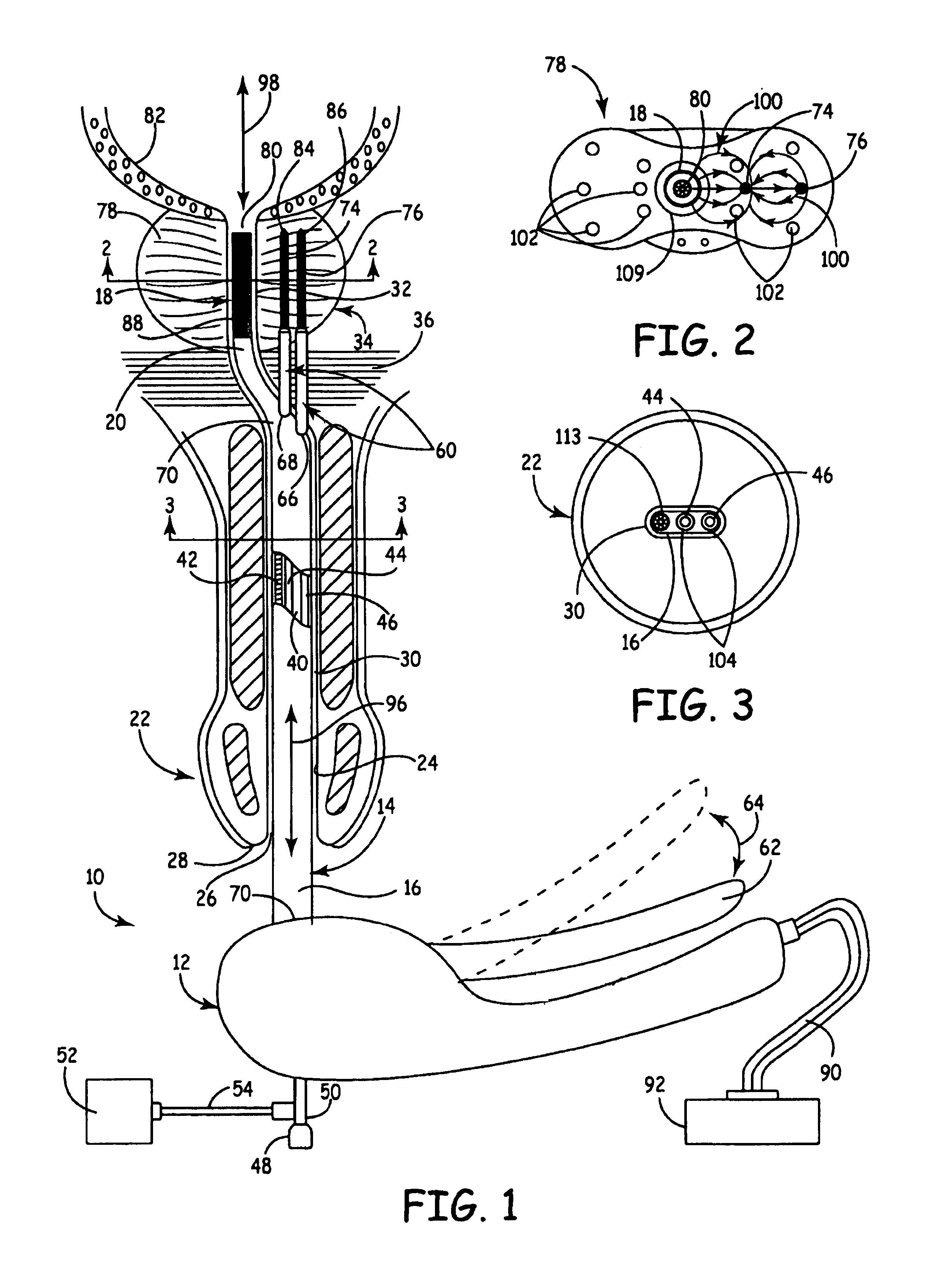 Apparatus and method for the treatment of benign prostatic hyperplasia