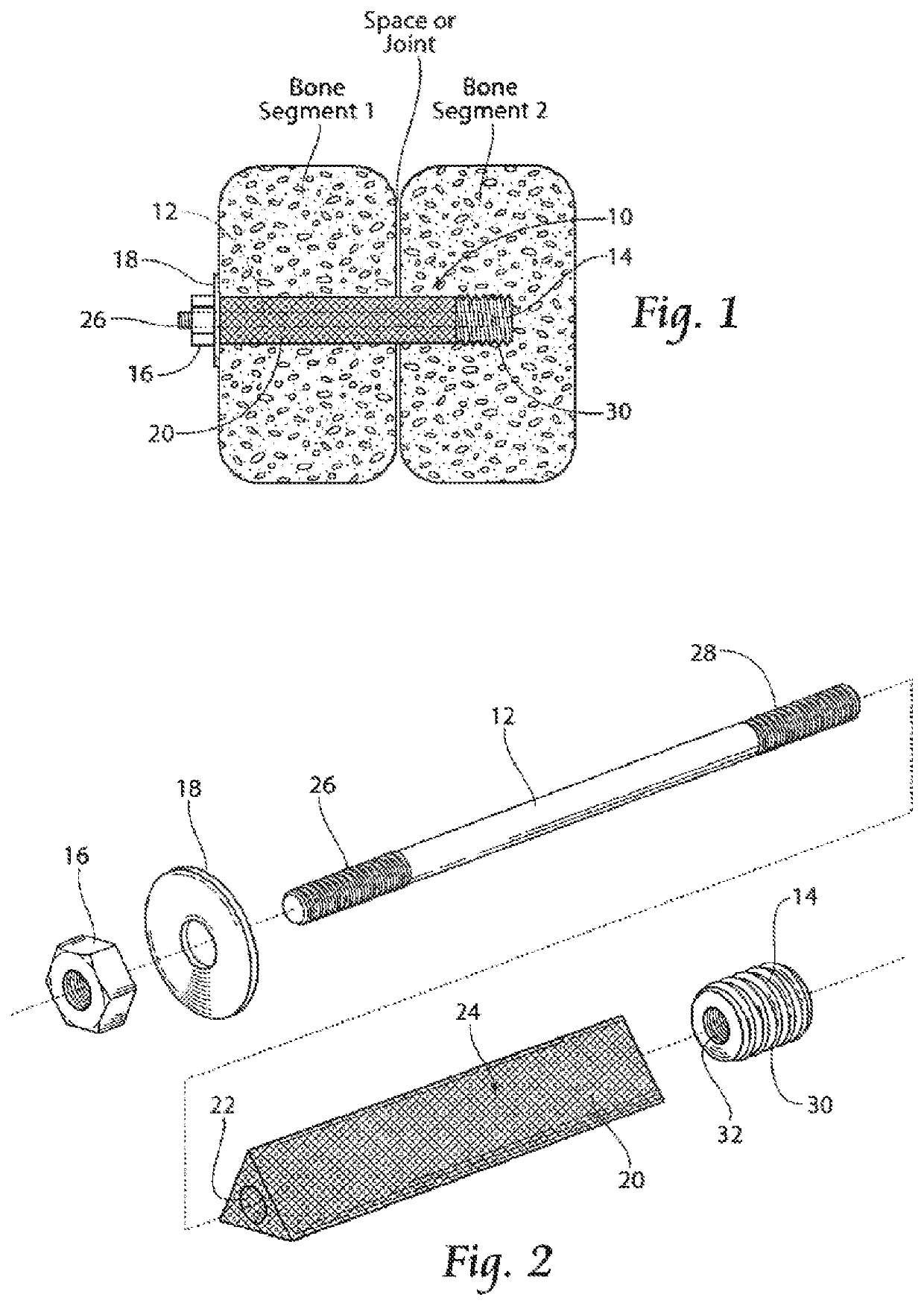 Apparatus, systems, and methods for the fixation or fusion of bone