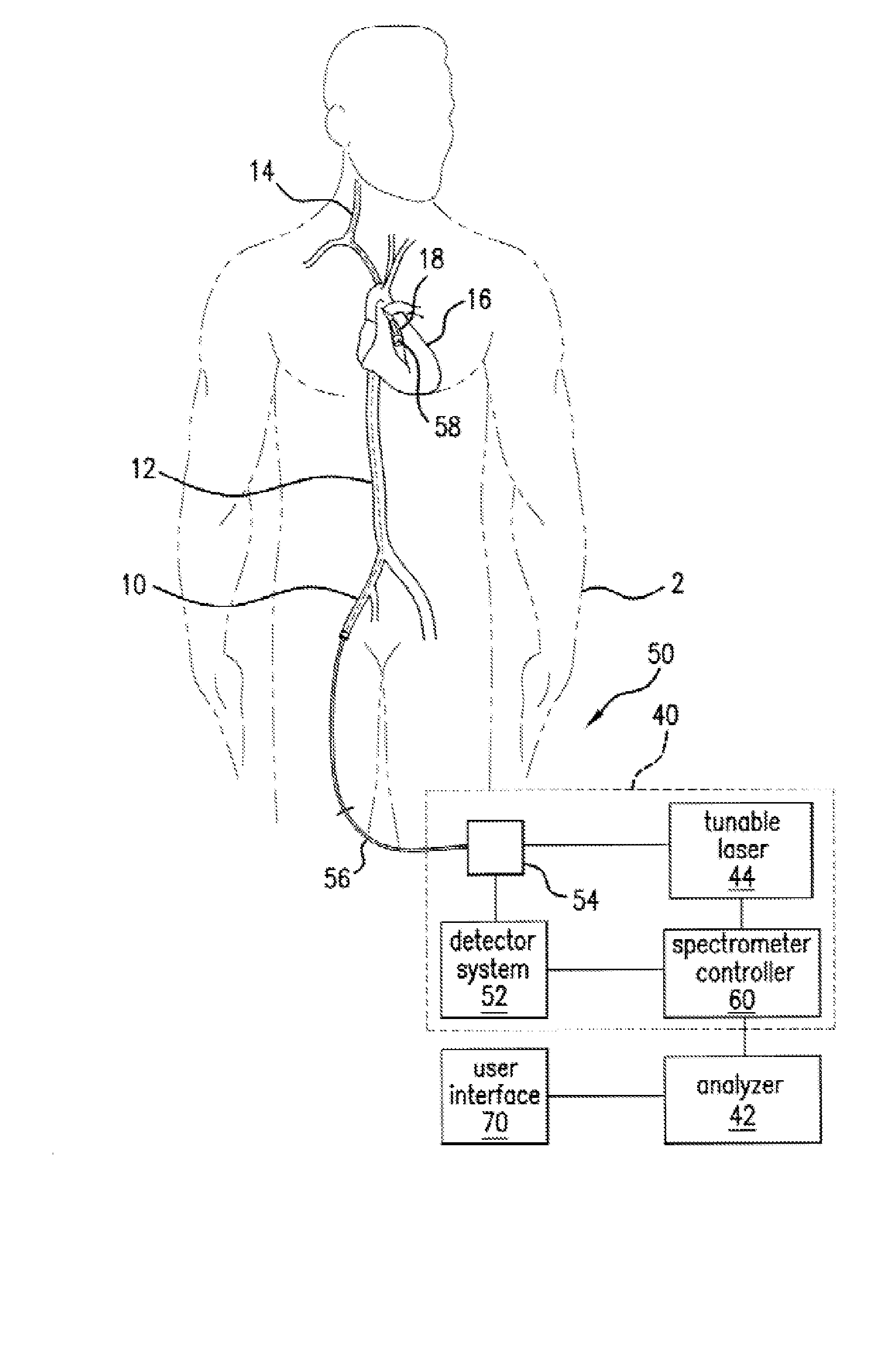 Method and System for Intra Luminal Thrombus Detection